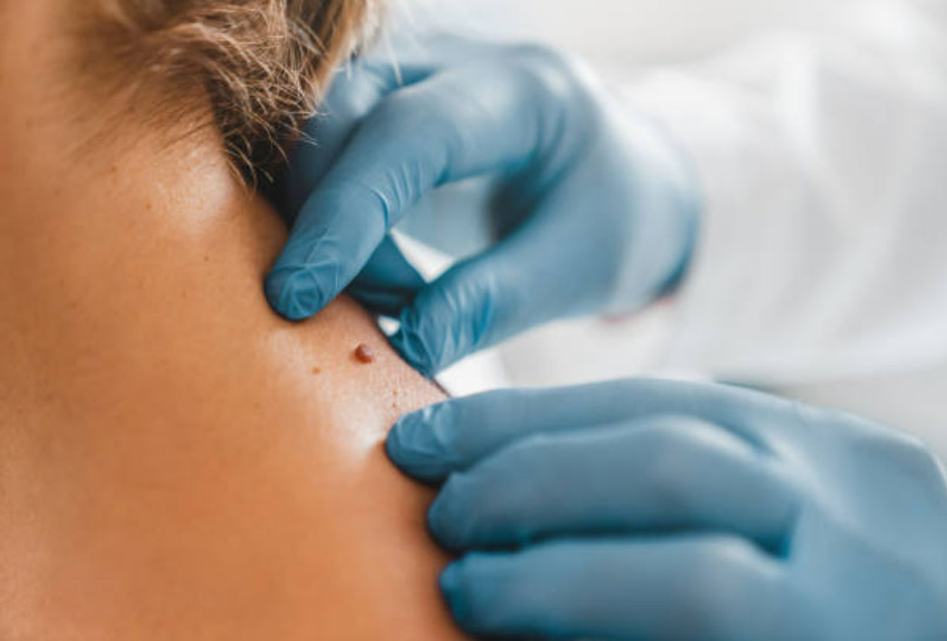 Petite chirurgie dermatologique