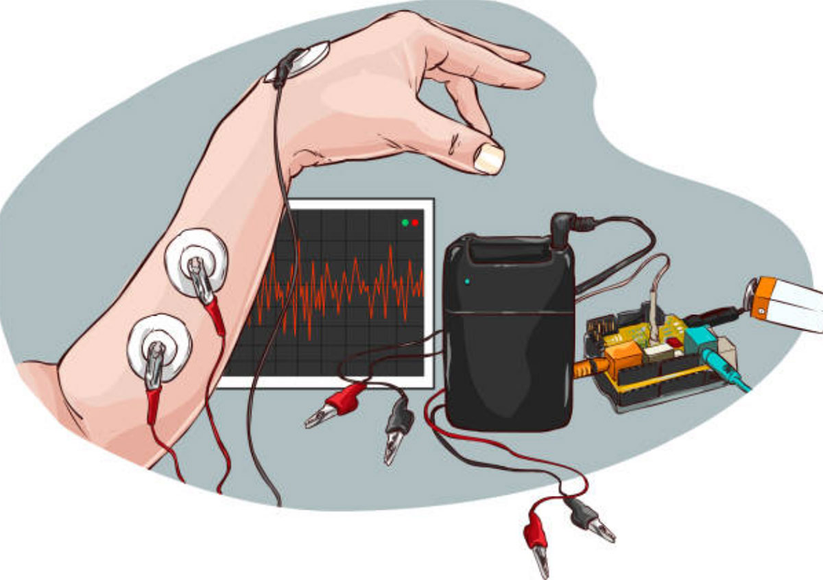 Electromyogrammes (EMG)