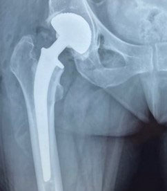 Chirurgie de la hanche