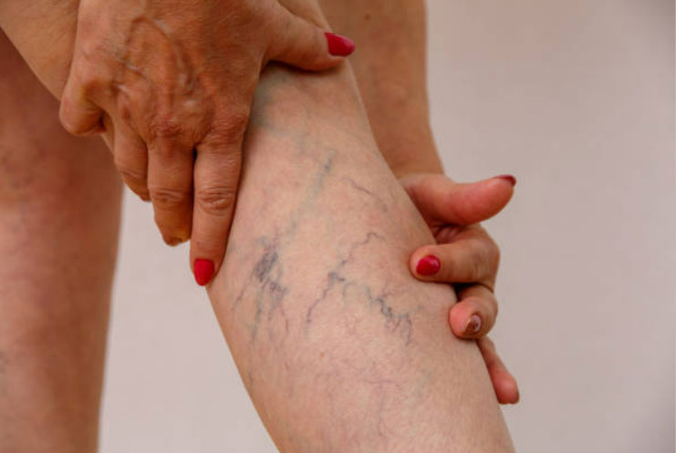 Chirurgie des varices